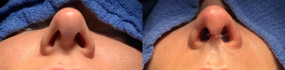 Revision Rhinoplasty before and after photo