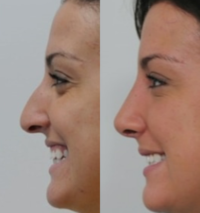 Rhinoplasty before and after photo