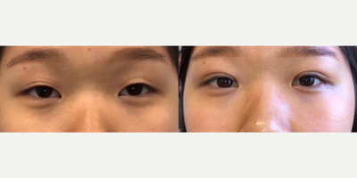 Double Eyelid Surgery before and after photo