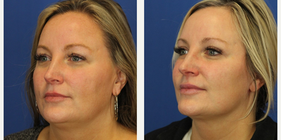 Mini Facelift before and after photo