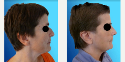 Rhinoplasty before and after photo