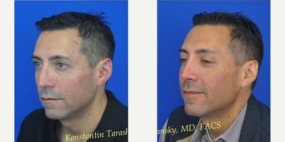 Rhinoplasty before and after photo