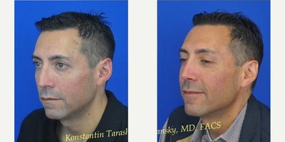 Rhinoplasty before and after photo