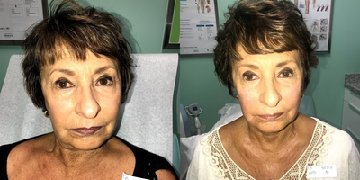 Skin Tightening before and after photo