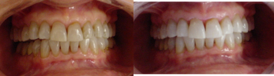 Teeth Whitening before and after photo