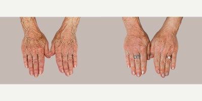 Hand Rejuvenation before and after photo