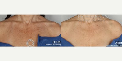 IPL before and after photo