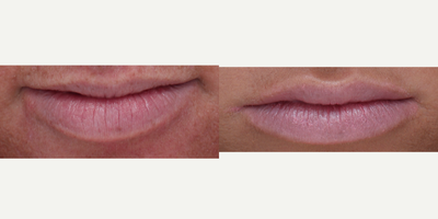 Juvederm before and after photo