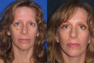 Facelift before and after photo