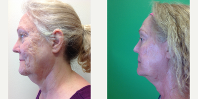FaceTite before and after photo