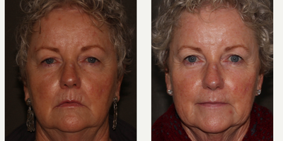 Voluma before and after photo