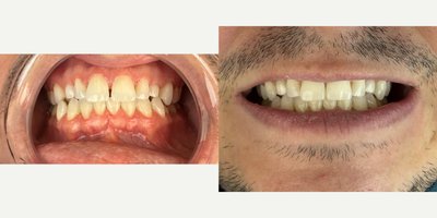 Clear Braces before and after photo