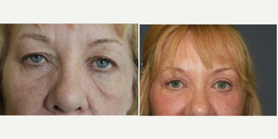 Eyelid Surgery before and after photo