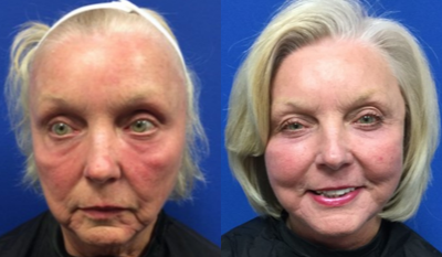 FaceTite before and after photo