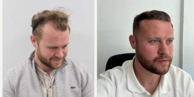 FUE Hair Transplant before and after photo