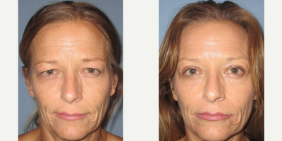 LASIK before and after photo
