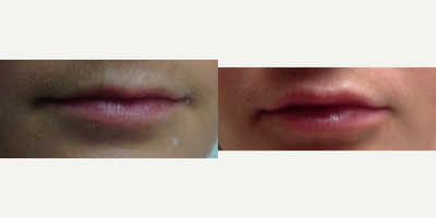 Lip Fillers before and after photo