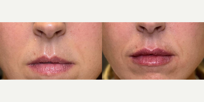 Lip Fillers before and after photo
