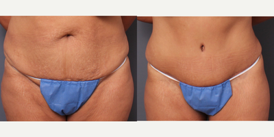 Tummy Tuck before and after photo