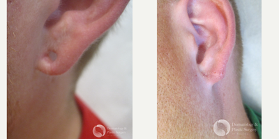 Earlobe Repair before and after photo