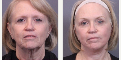 Facelift before and after photo