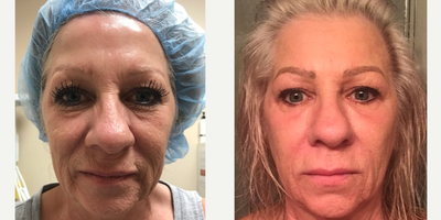 IPL before and after photo