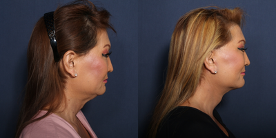 Neck Lift before and after photo