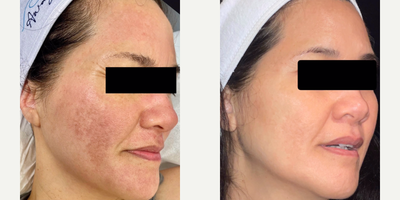 Secret RF before and after photo