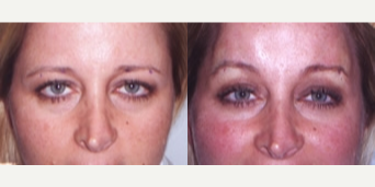 Thread Lift before and after photo