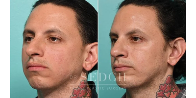 Chin Implant before and after photo