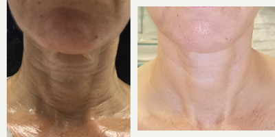 Fractional Laser before and after photo