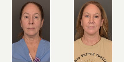 Neck Lift before and after photo