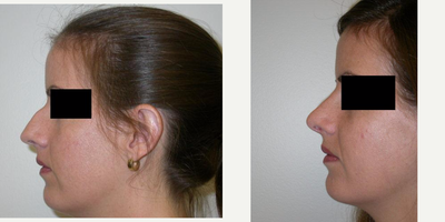 Rhinoplasty before and after photo