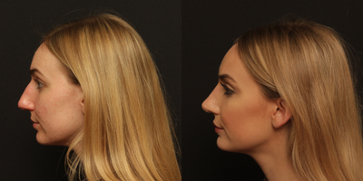 Septoplasty before and after photo