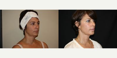 Ultherapy before and after photo