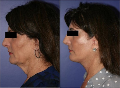 Botox before and after photo