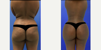 Brazilian Butt Lift before and after photo