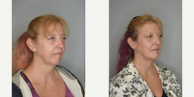 Chin Implant before and after photo