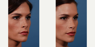 Rhinoplasty before and after photo