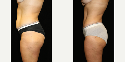 Tummy Tuck before and after photo