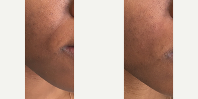 Vollure before and after photo