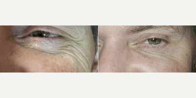 Botox before and after photo