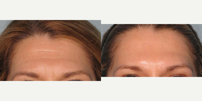 Botox before and after photo