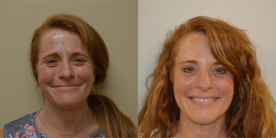Botox before and after photo
