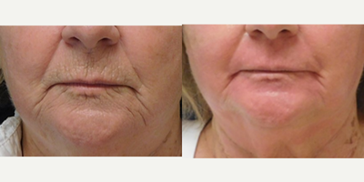 Chemical Peel before and after photo