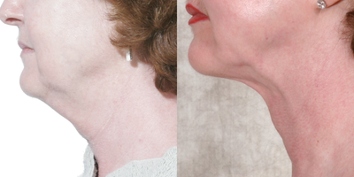 Kybella before and after photo