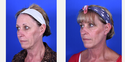 Mini Facelift before and after photo