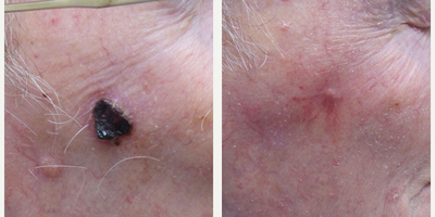 Mole Removal before and after photo