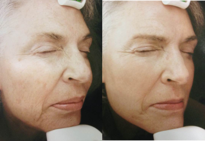 ActiveFX before and after photo