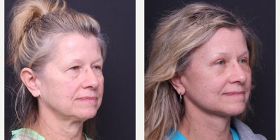 Eyelid Surgery before and after photo
